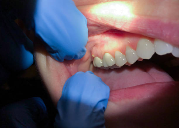 Best Knocked-Out Tooth (Avulsed Tooth) Treatment in Kyle, SD