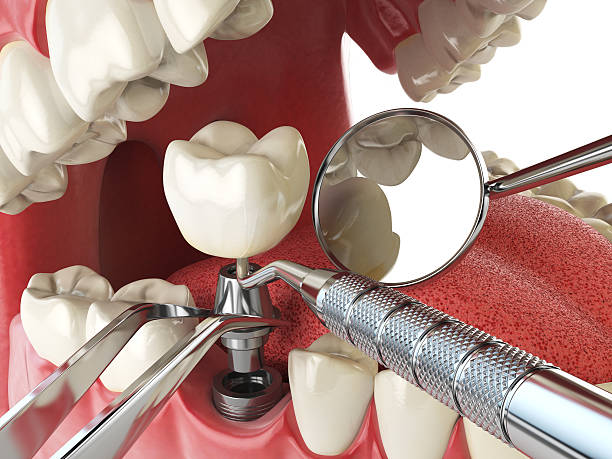 Best Dental Abscess Treatment in Kyle, SD